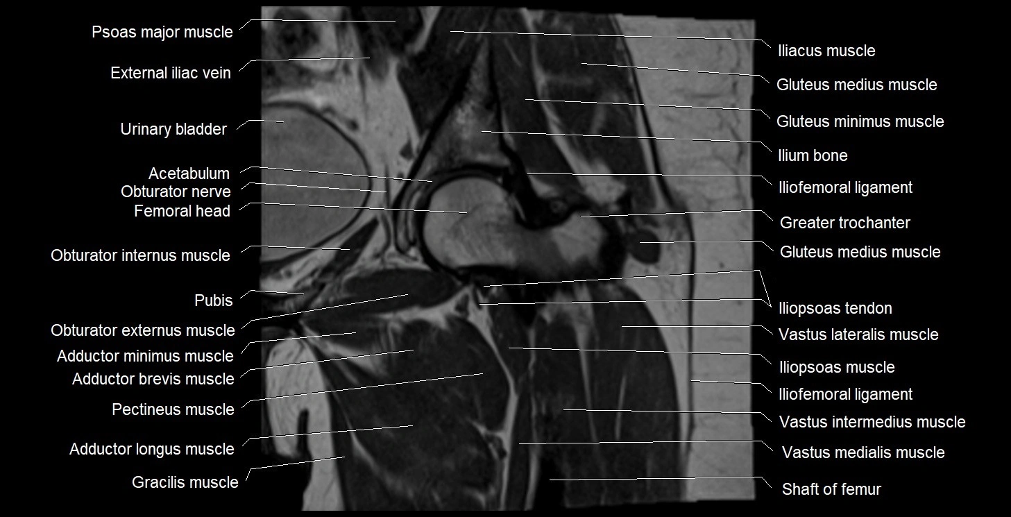 MRI Hip 3T coronal cross sectional anatomy image 28.webp